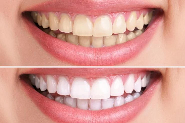 Teeth Whitening