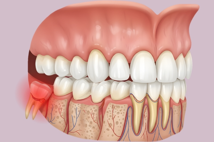 Wisdom Tooth Removal